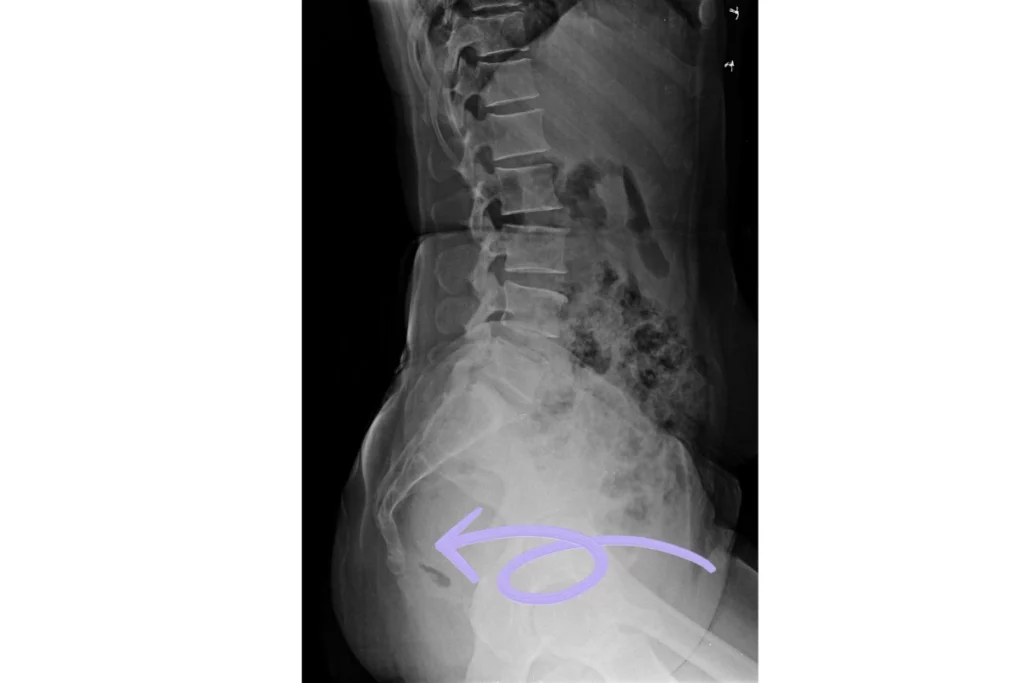 X-rays of the sacrum and coccyx