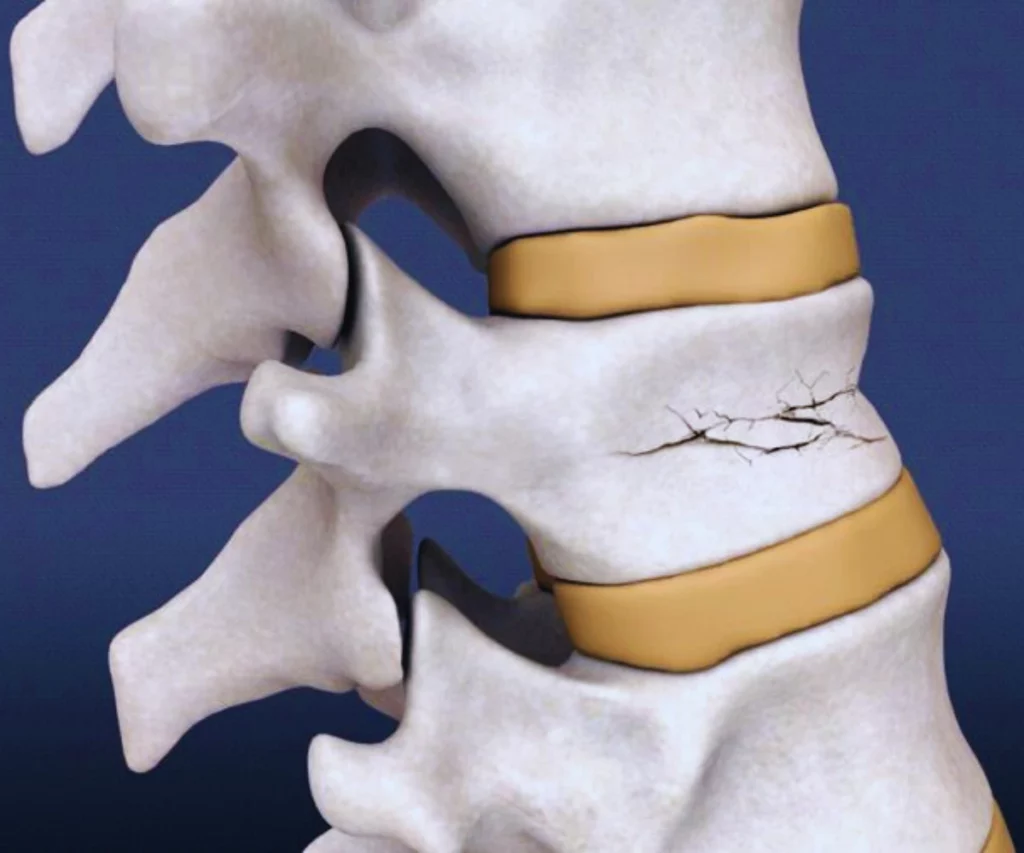 Spinal fracture