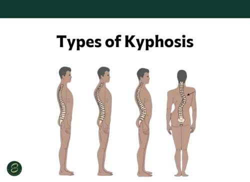Types of Kyphosis