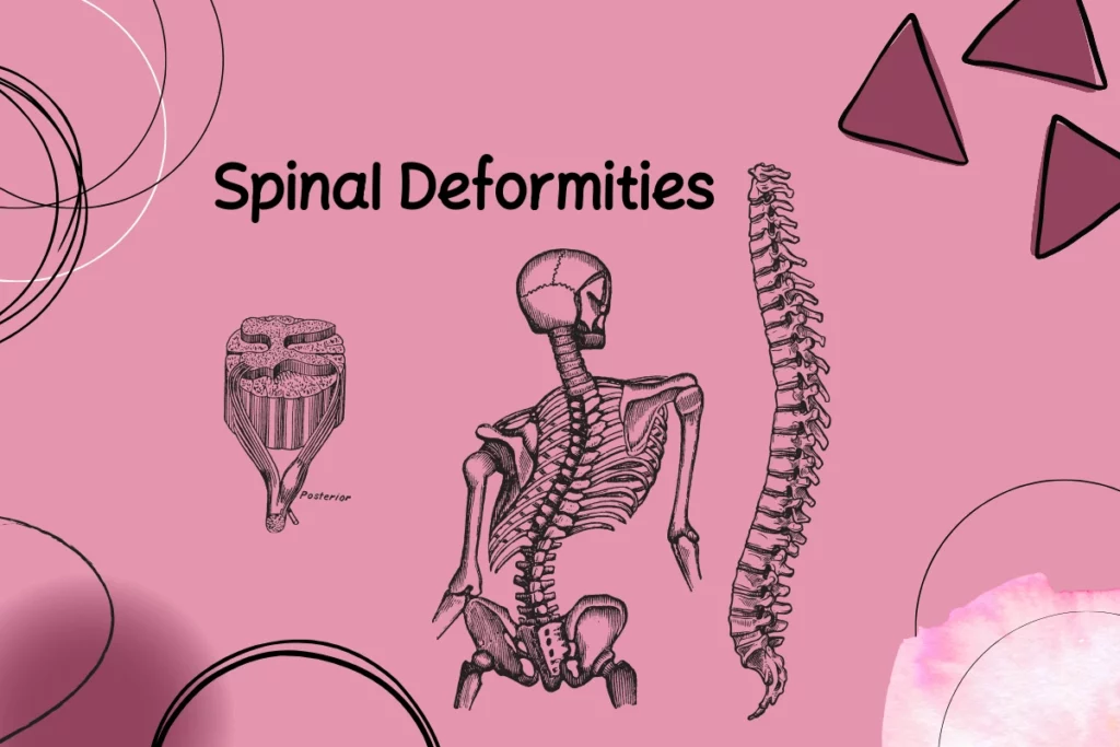 Spinal Deformities