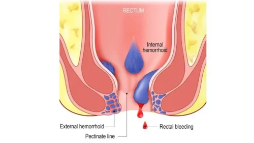 internal and external hemorrhoids